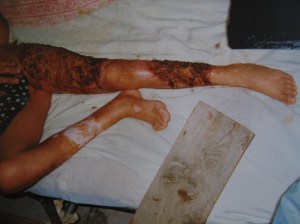 Mushvig's burns after cleaning at the hospital